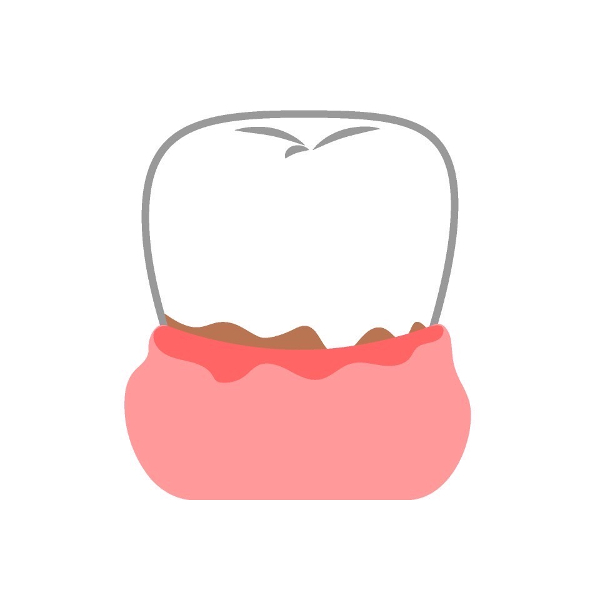 港南台パーク歯科クリニック｜ブログ｜歯茎下がり、気になりませんか？｜虫歯になりやすくなる