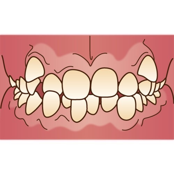 港南台パーク歯科クリニック｜ブログ｜歯茎下がり、気になりませんか？｜噛み合わせが悪い