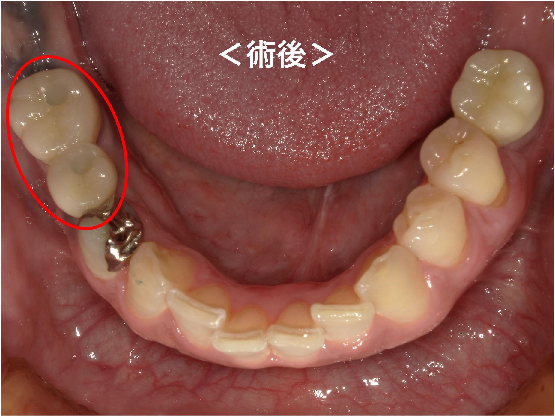 港南台パーク歯科クリニック｜症例｜【症例】標準的な奥歯のインプラント治療｜治療後口腔内写真