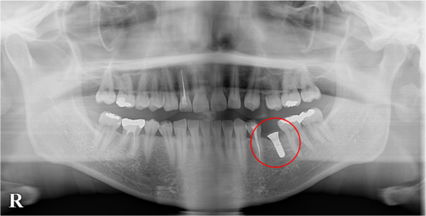 港南台パーク歯科クリニック｜症例｜【症例】先天性欠如歯に対するインプラント治療｜インプラントを埋入後のレントゲン画像