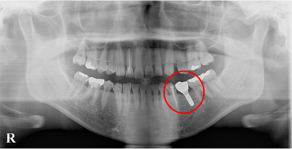 港南台パーク歯科クリニック｜症例｜【症例】先天性欠如歯に対するインプラント治療｜港南台パーク歯科クリニック｜症例｜【症例】先天欠如歯に対するインプラント治療｜インプラント後の被せ物セット後のレントゲン画像
