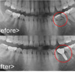 港南台パーク歯科クリニック｜症例｜【症例】先天性欠如歯に対するインプラント治療｜ビフォアフターレントゲン画像