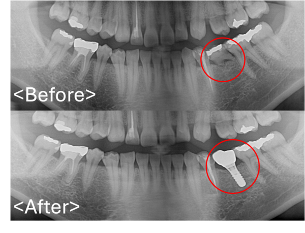 港南台パーク歯科クリニック｜症例｜【症例】先天性欠如歯に対するインプラント治療｜ビフォアフターレントゲン画像