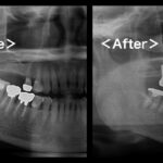港南台パーク歯科クリニック｜症例｜【症例】骨が不足している上顎の奥歯のインプラント治療｜アイキャッチ画像
