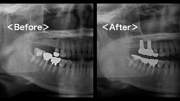 港南台パーク歯科クリニック｜症例｜【症例】骨が不足している上顎の奥歯のインプラント治療｜アイキャッチ画像