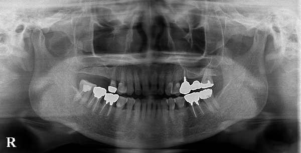港南台パーク歯科クリニック｜症例｜【症例】骨が不足している上顎の奥歯のインプラント治療｜治療前画像