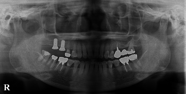港南台パーク歯科クリニック｜症例｜【症例】骨が不足している上顎の奥歯のインプラント治療｜治療詳細画像②