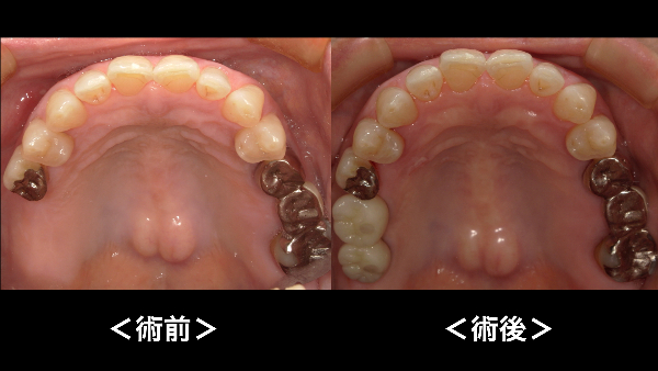 港南台パーク歯科クリニック｜症例｜【症例】骨が不足している上顎の奥歯のインプラント治療｜治療詳細画像④