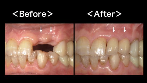 港南台パーク歯科クリニック｜症例｜歯根破折にて抜歯になった前歯のインプラント治療｜アイキャッチ画像
